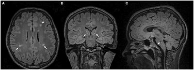 Case report: Unilateral GPi DBS in secondary myoclonus-dystonia syndrome after acute disseminated encephalomyelitis